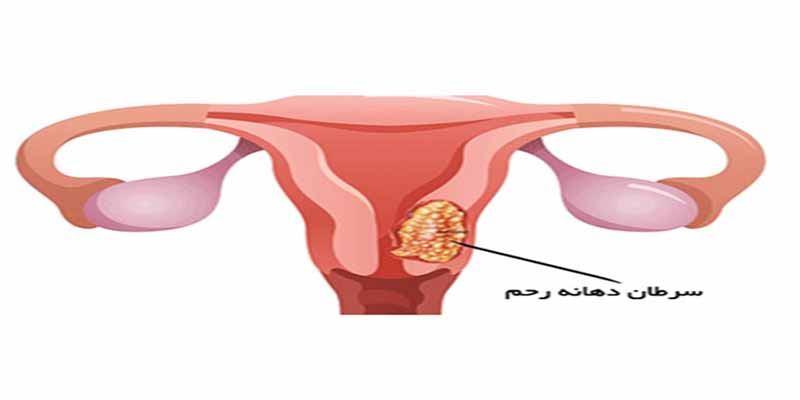 سرطان دهانه رحم و درمان قطعی