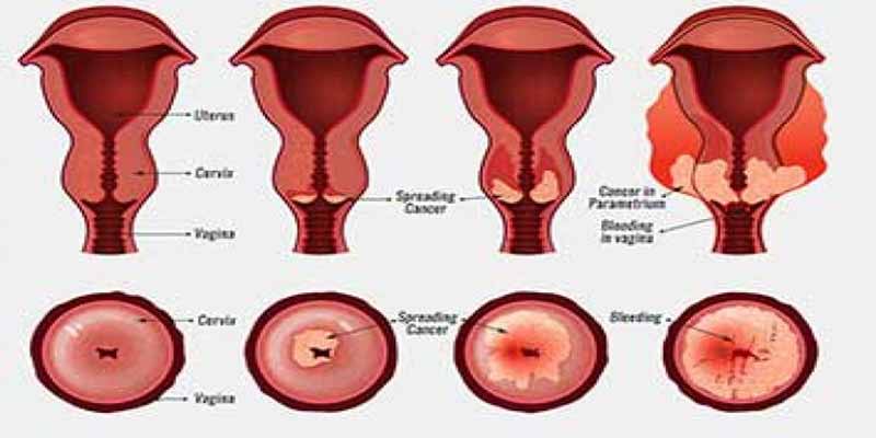 سرطان دهانه رحم و درمان 9