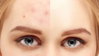 20 روش طبیعی درمان جوش صورت در منزل