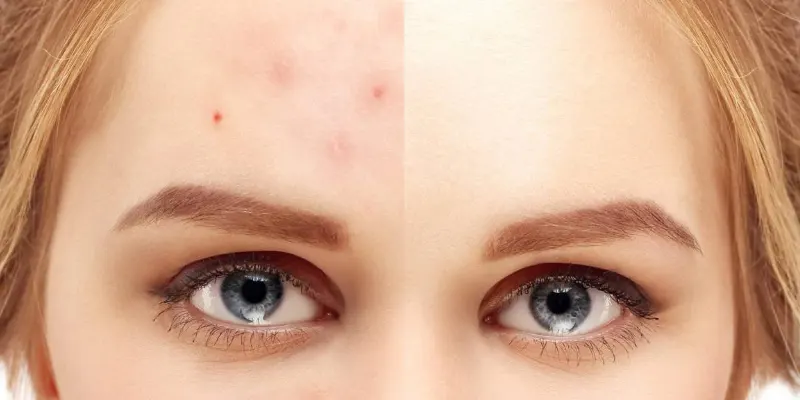 20 روش طبیعی درمان جوش صورت در منزل