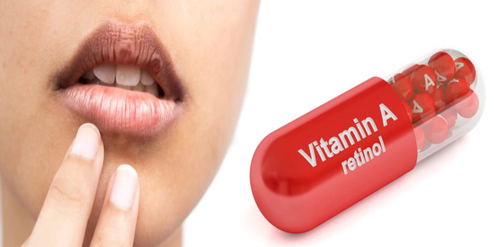 کمبود کدام ویتامین باعث خشکی دهان می شود و راه درمان آن