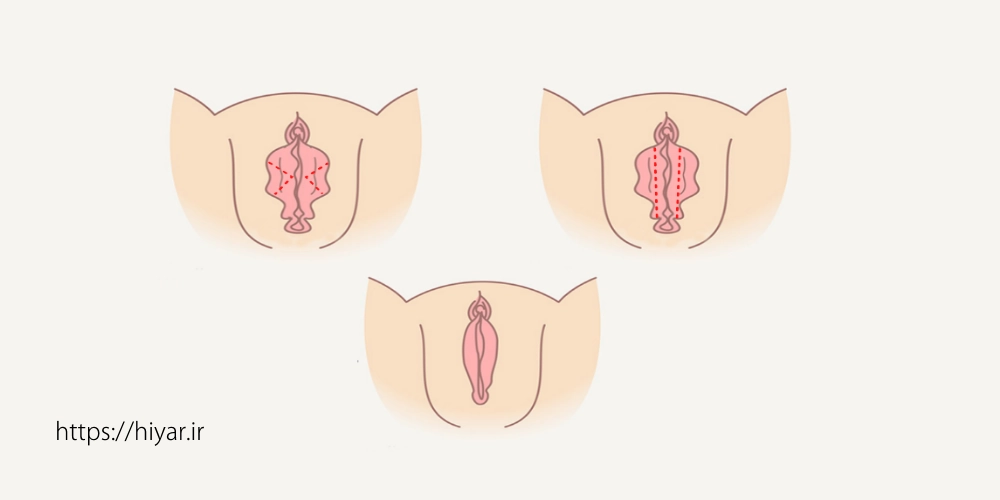 عمل زیبایی واژن یا لابیاپلاستی