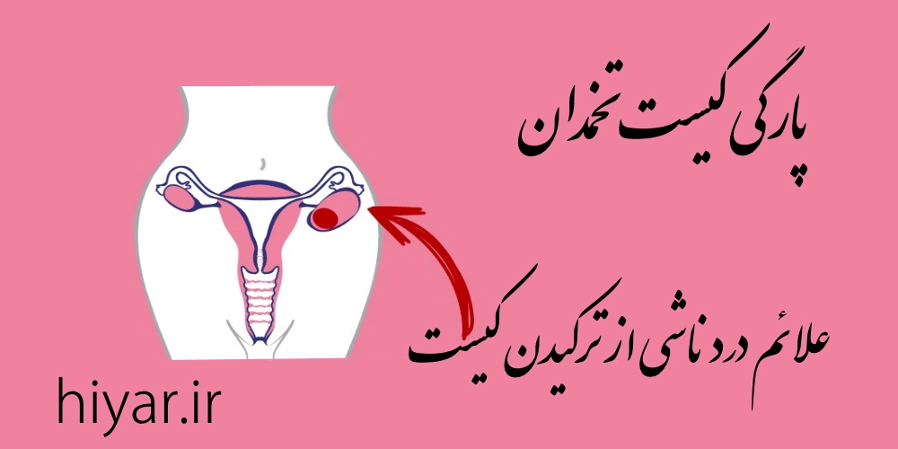 پارگی کیست تخمدان: علائم درد ناشی از ترکیدن کیست