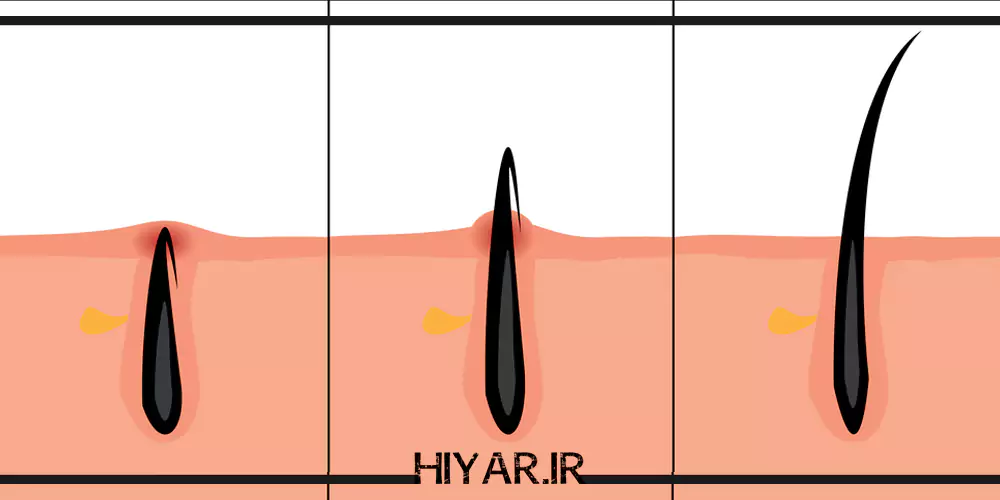 علل و درمان موهای زیر پوستی