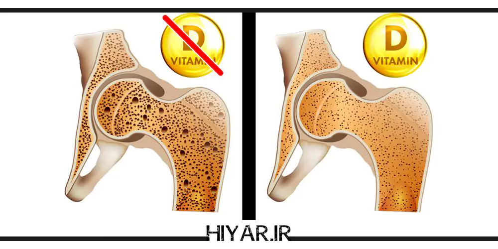 کمبود ویتامین D، مشکلی فراتر از استخوان‌ها